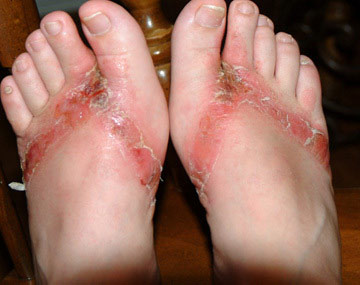 Dermatite de contacto