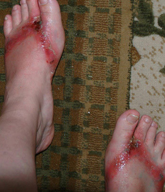 Dermatitis