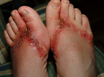 Dermatite nos pés